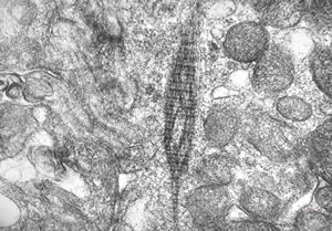 F,5y. | immotile cilia syndrome - rootlet of kinocilia F,5y. | immotile cilia syndrome - rootlet of kinocilia